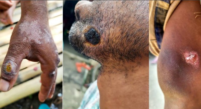 রংপুরে অ্যানথ্রাক্স আতঙ্ক: দুই শতাধিক গরুর মৃত্যু, আক্রান্ত বহু মানুষ 