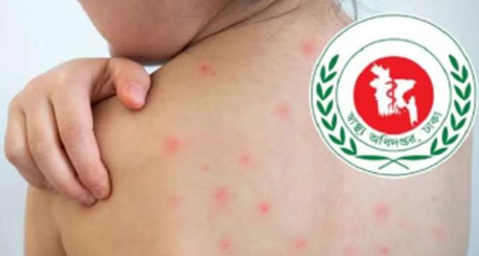 ২৪ ঘণ্টায় হাম ও উপসর্গে ১১ মৃত্যু